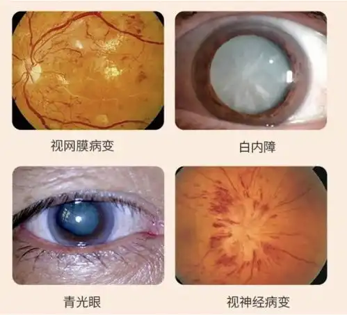  300斤男子患糖尿病多年竟不知,险致失明