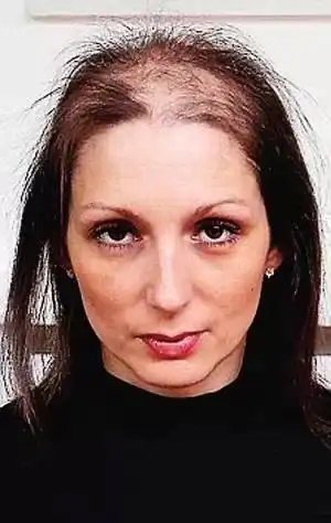女性秃头表情包哈钦斯