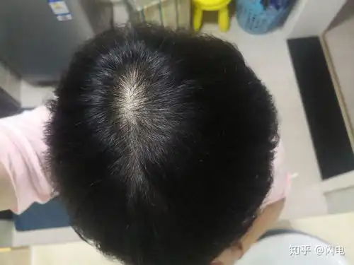  秃头少女,脂溢性脱发记录文