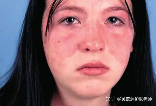  鼻子周围长红包长红疹子是激素皮炎还是玫瑰痤疮