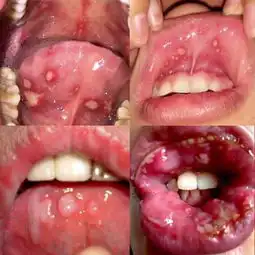  高能口腔溃疡怎么办这篇牙医良心文告诉你