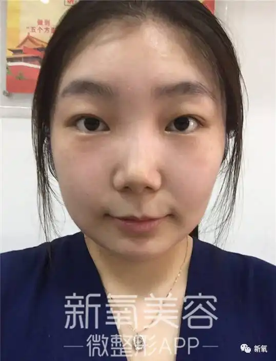  袁姗姗脸肿成甩饼就算了,这鼻子也平了莫非是被肉挤得