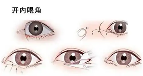 双十一来了,如何优雅的做双眼皮 双十一来了,如何优雅的做双眼皮