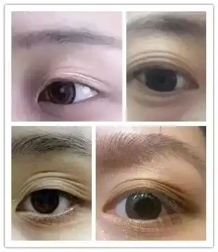 惊再这样贴双眼皮,小心神仙也救不了你 惊再这样贴双眼皮,小心神仙也救不了你