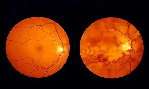  糖尿病眼底出血反反复复,如何破中医治疗眼底出血攻略