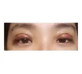 术前是典型的内双,平时都需要贴双眼皮啦做了定点...双眼皮悦美整形 术前是典型的内双,平时都需要贴双眼皮啦做了定点...双眼皮悦美整形