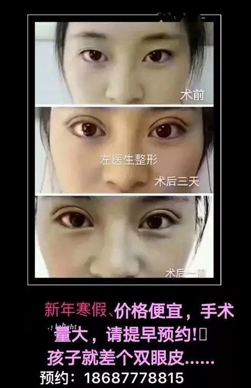 警示双眼皮贴再用下去,神仙都救不了你 警示双眼皮贴再用下去,神仙都救不了你