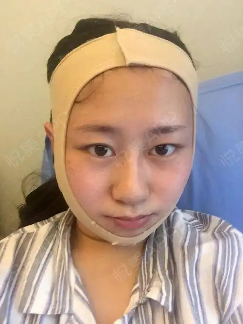  术后第五天了,我已经拔了管子,也拆包了,不觉得痛就...磨骨悦美整形