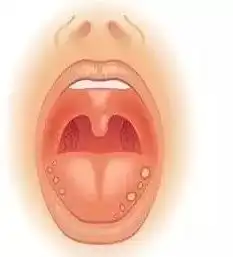  口腔溃疡到底有多疼口腔科医生带来了一堆干货给你