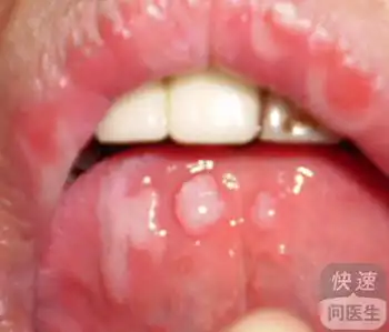  口腔溃疡可以分为哪几种类型口腔溃疡的三种类型