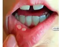 口腔溃疡难受表情包