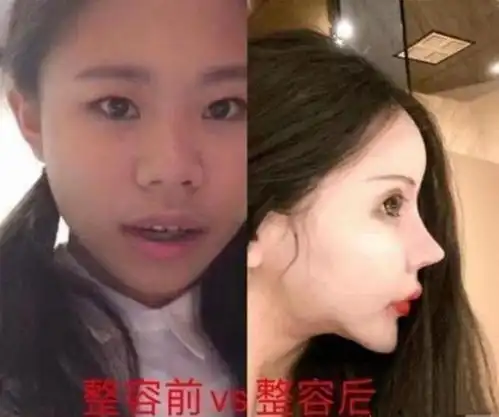  三年花费近百万,整容60次的网红女孩现今如何妈妈判若两人