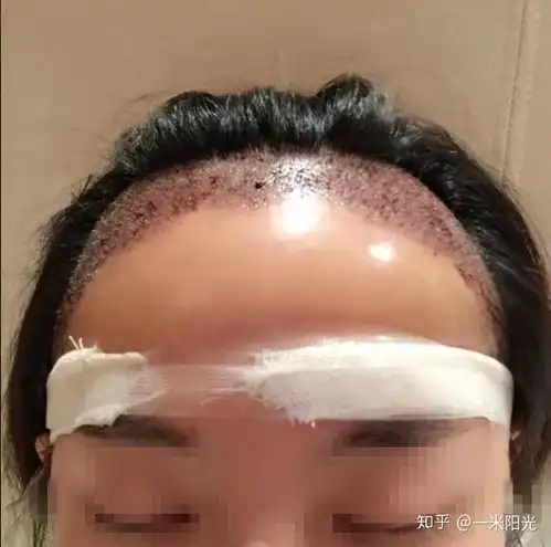  花季少女脱发秃头是种什么样的体验及发型选择问题