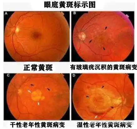  问下和我一样20多岁就得了黄斑病变眼底新生血管的你们现在怎么样了