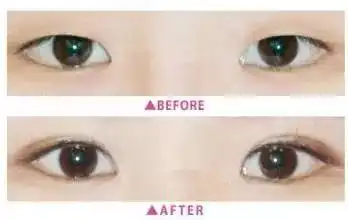 是时候,扔了双眼皮贴 是时候,扔了双眼皮贴